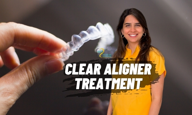 Clear Aligner Treatment: Your Guide to Invisible Braces