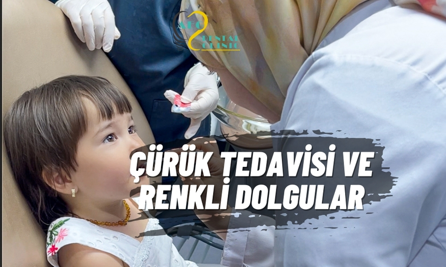 Süt Dişlerinde Çürük Tedavisi ve Renkli Dolgular