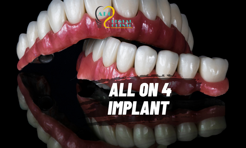 All-on-4 Implants: Fixed Teeth