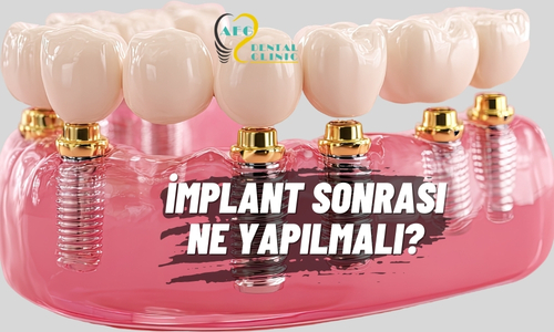 İmplant Sonrası Bakım