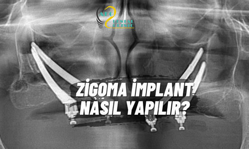 Zigoma İmplant Tedavisi