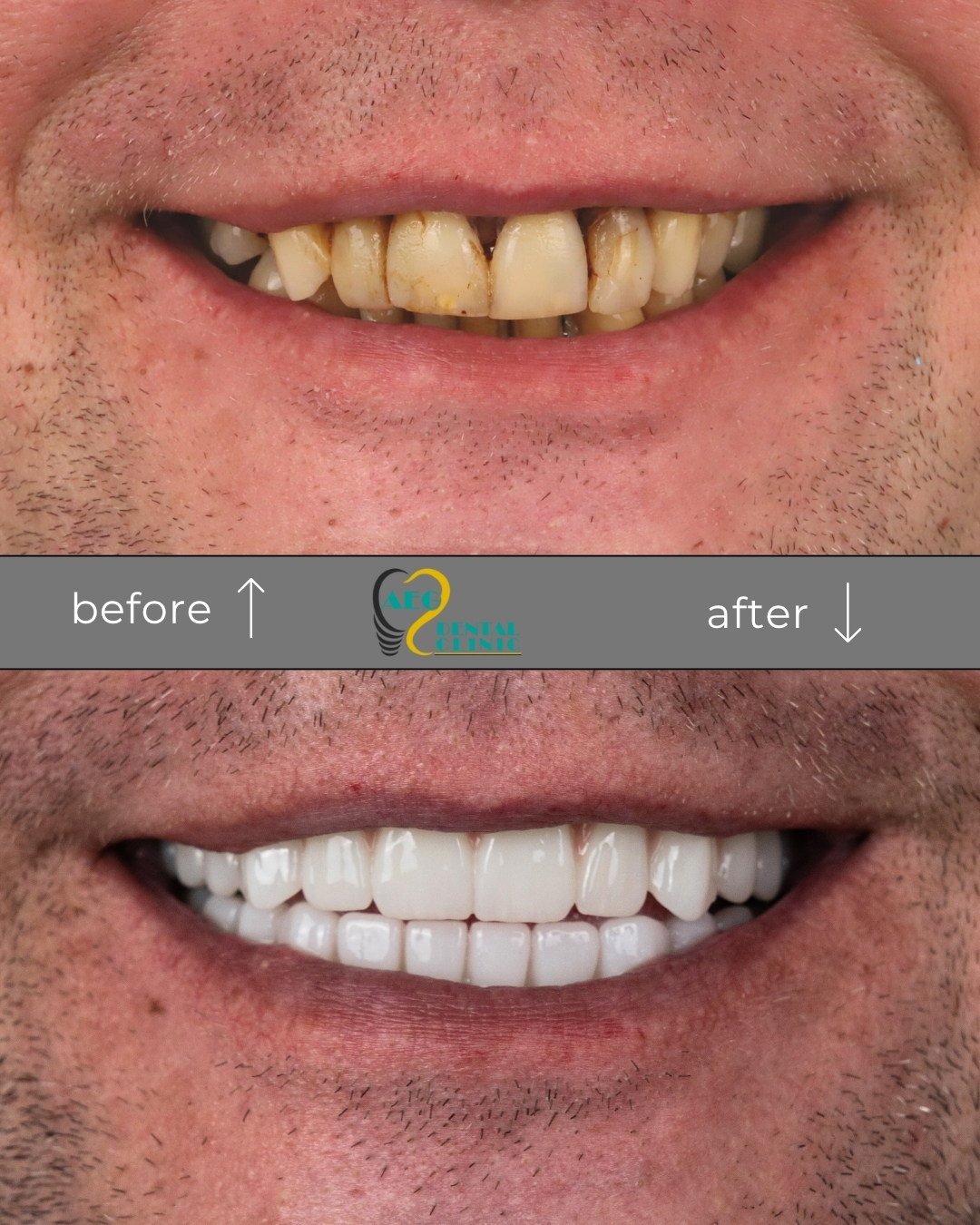 All on 4 Dental Implants Turkey